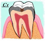 う蝕の進行　Ｃ1.jpg