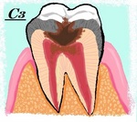 う蝕の進行　Ｃ3.jpg