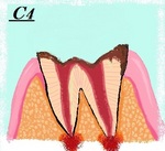 う蝕の進行　Ｃ4.jpg