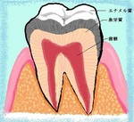 う蝕の進行.jpg